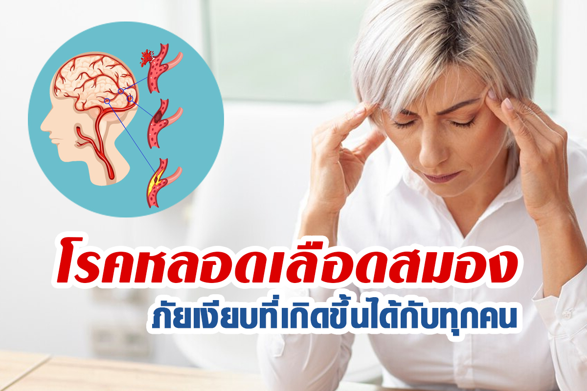 โรคหลอดเลือดสมอง